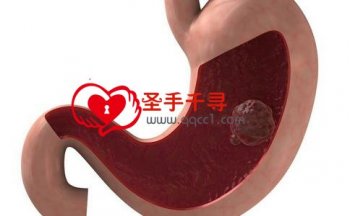 导致胃癌的致命因素 胃癌的严重程度和哪些因素