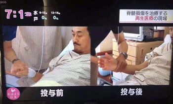 日本国家电视台NHK报导的先端再生医疗，干细胞