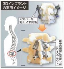 【腰椎变性研究动态】多种原因造成腰椎间盘弹