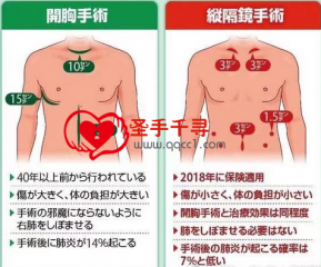 食道癌治疗动态-纵隔镜手术在日本